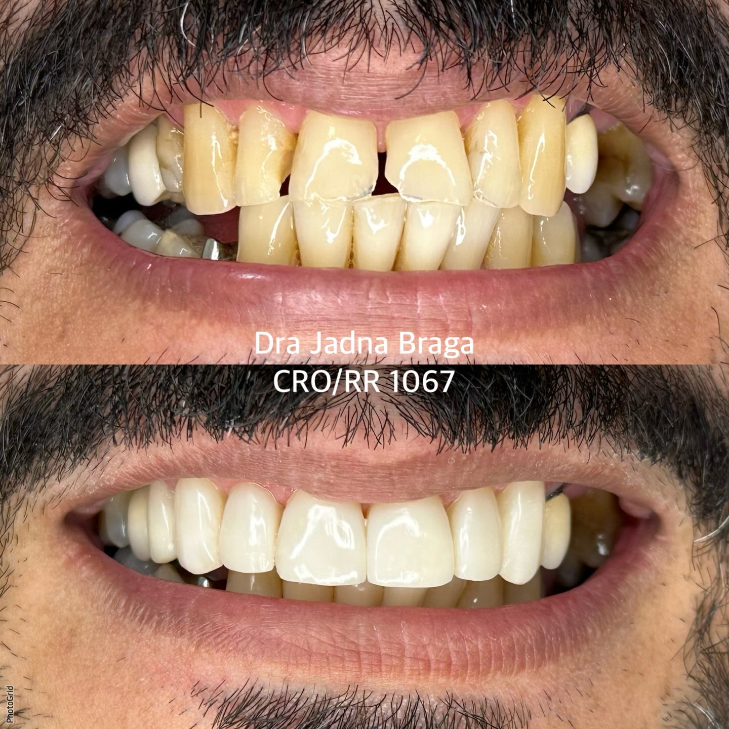 Antes e depois de caso clínico 2 realizado pela Dra. Jadna Braga