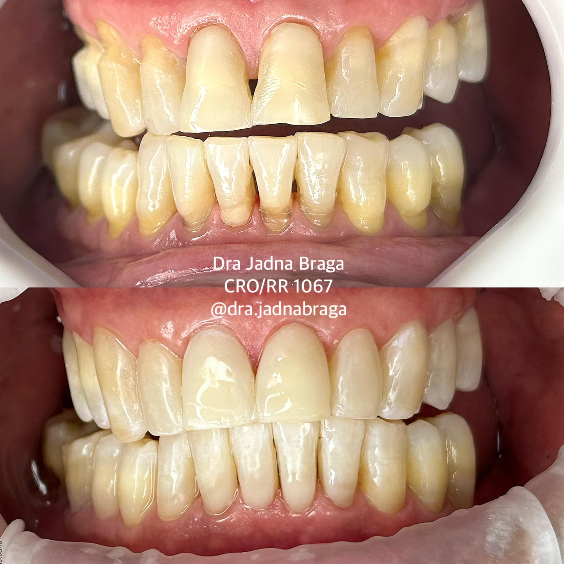 Antes e depois de caso clínico 1 realizado pela Dra. Jadna Braga