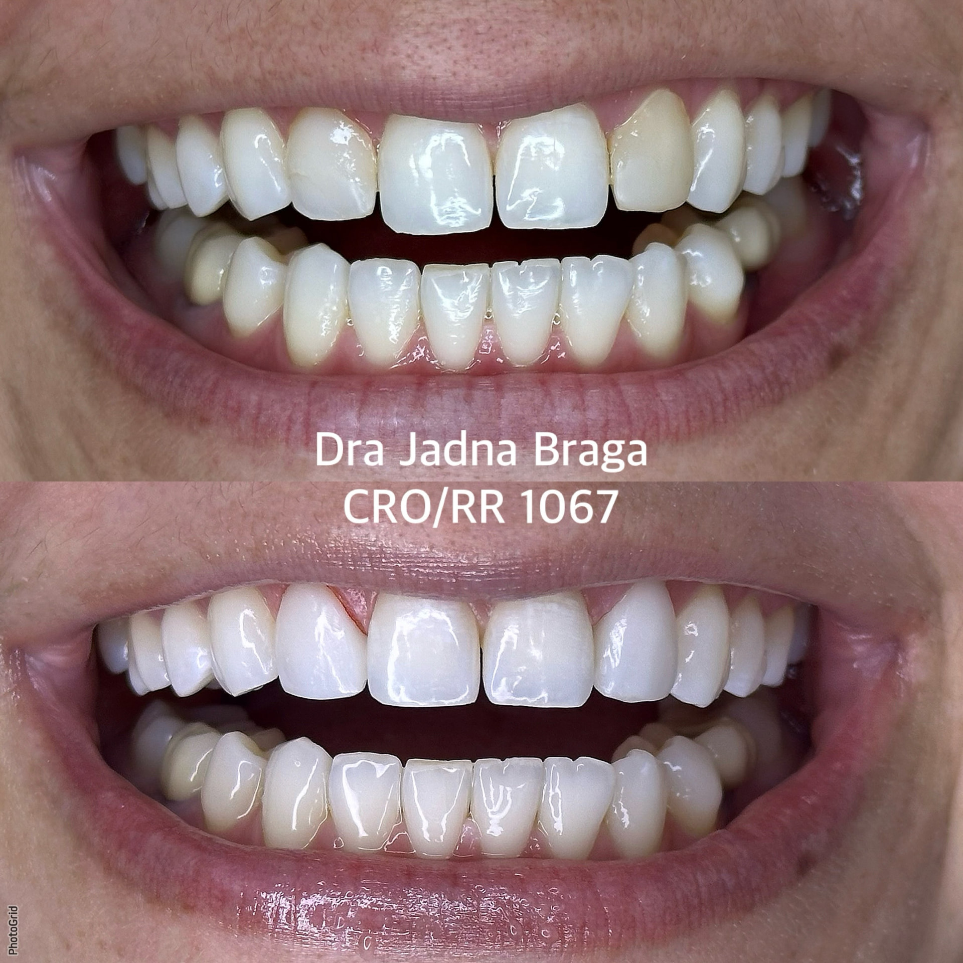 Antes e depois de caso clínico 3 realizado pela Dra. Jadna Braga
